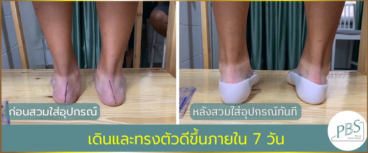 PBS แผ่นรองเท้าเพื่อสุขภาพ แก้รองช้ำ แก้ปวดเท้า โรคเท้าแบน
